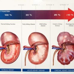 Kidney chronic anejo