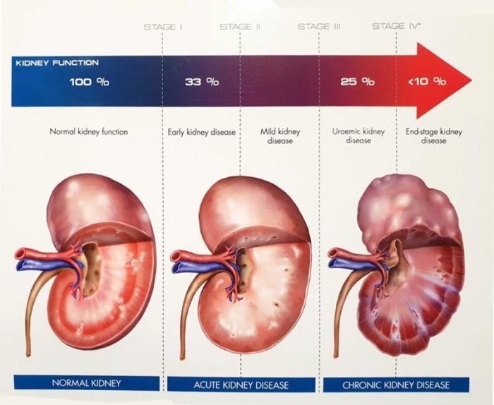 Kidney chronic anejo