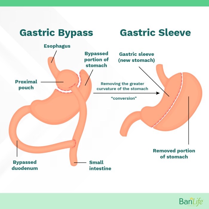 Can you have an ng tube after gastric bypass