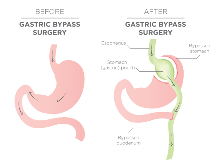 Can you have an ng tube after gastric bypass